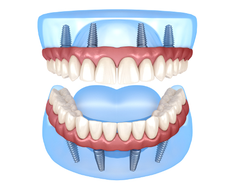 Feste Zahnprothese auf 4 Implantaten – Dr. Kim Bad Homburg